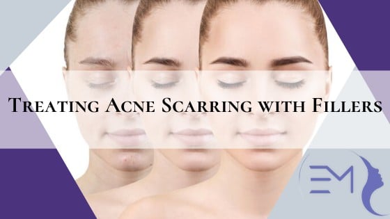 Treating Acne Scarring with Fillers