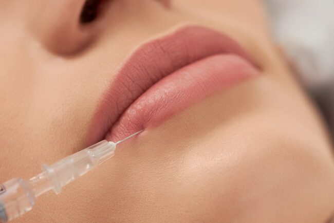 procedure lip augmentation